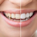 بلیچینگ دندان چیست | مراحل انجام + هزینه | دوام بلیچینگ 31 بلیچینگ دندان یکی از بهترین راههای برای داشتن دندانهای سفید و زیبا است.