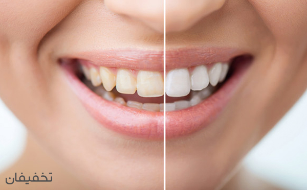 بلیچینگ دندان یکی از بهترین راه‌های برای داشتن دندان‌های سفید و زیبا است.