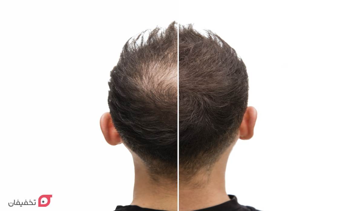 میکروپیگمنتیشن مو چیست؟