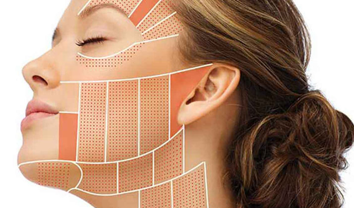 هایفوتراپی صورت و گردن روشی بسیار محبوب برای جوانسازی پوست است.