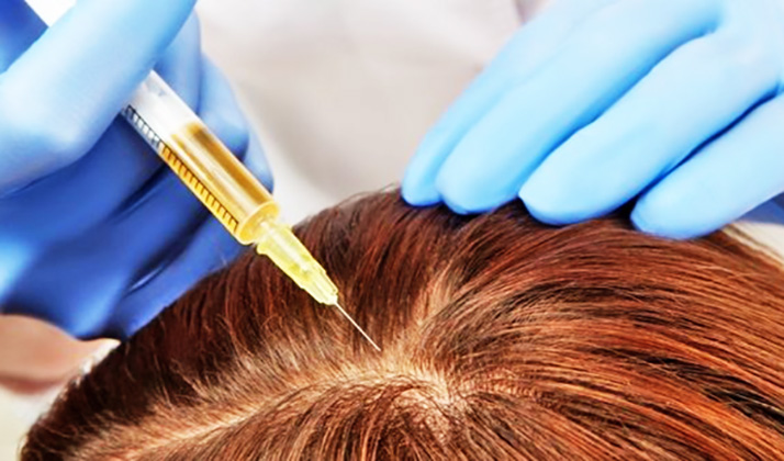 مزوتراپی مو سر به جلوگیری از ریزش موها کمک می‌کند.