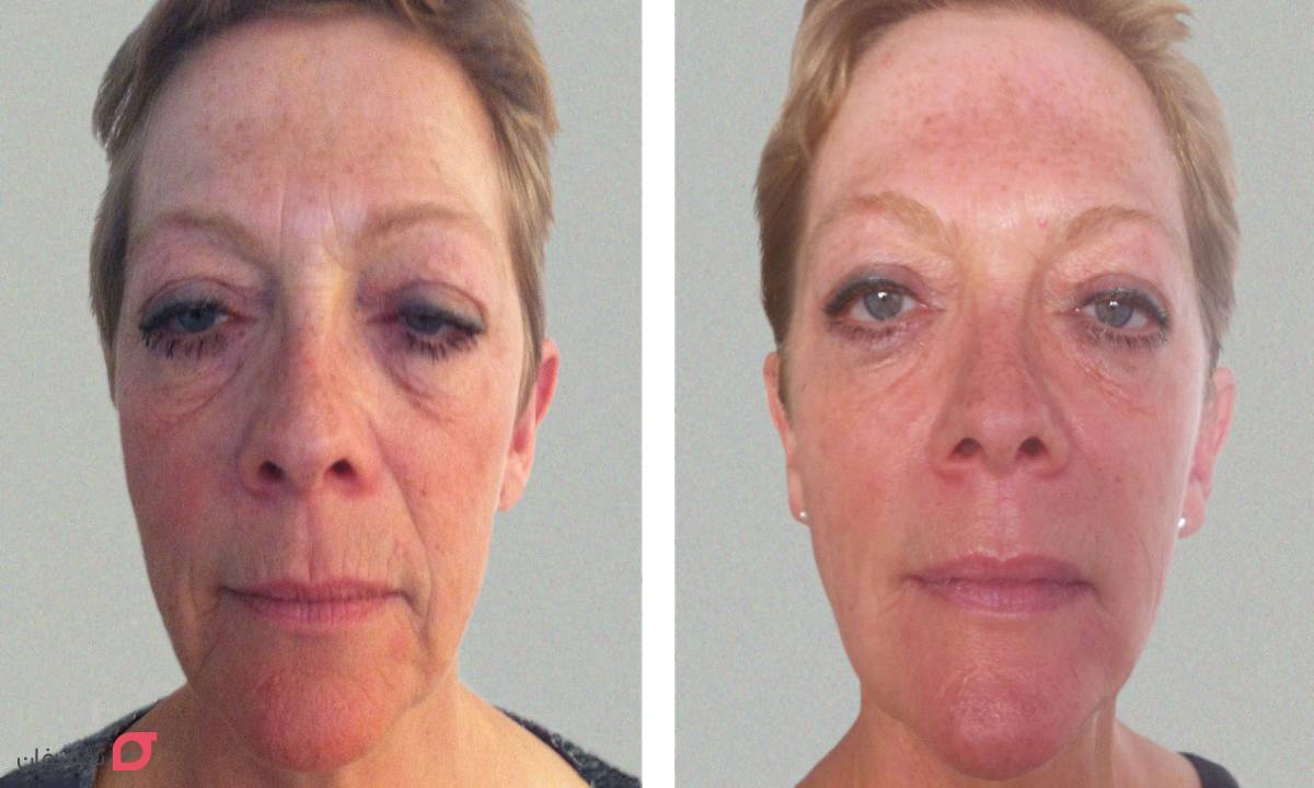 عکس قبل و بعد مزوتراپی 