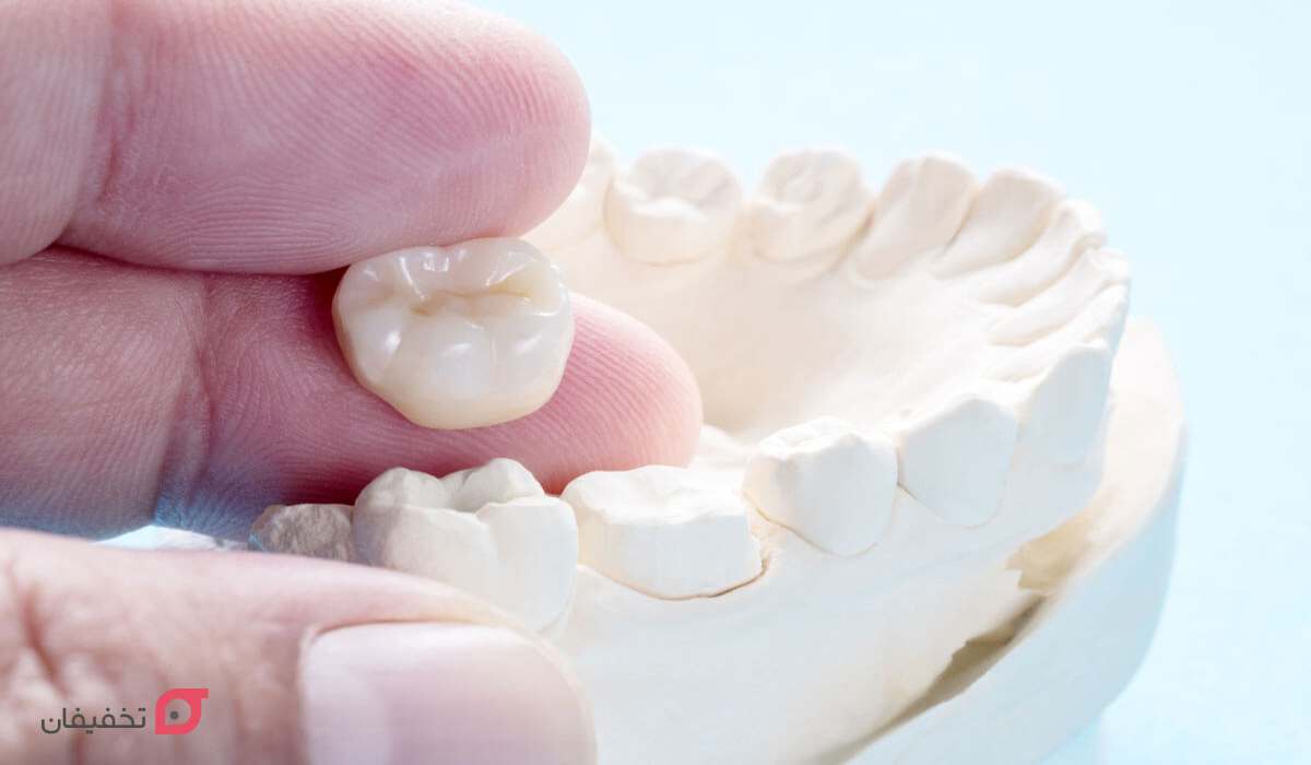 طول عمر روکش دندان چقدر است؟
