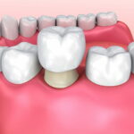 روکش دندان چیست؛ طول عمر و قیمت انواع روکش + مزایا و معایب 28 روکش دندان ثابت یا روکش دندان موقت در تصویر نمایش داده شده است