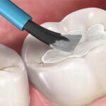 فیشور سیلانت دندان چیست | مزایا و عوارض شیاربندی دندان کودکان 27 فیشور سیلانت دندان یا شیاربندی دندان ها با ماده مخصوص