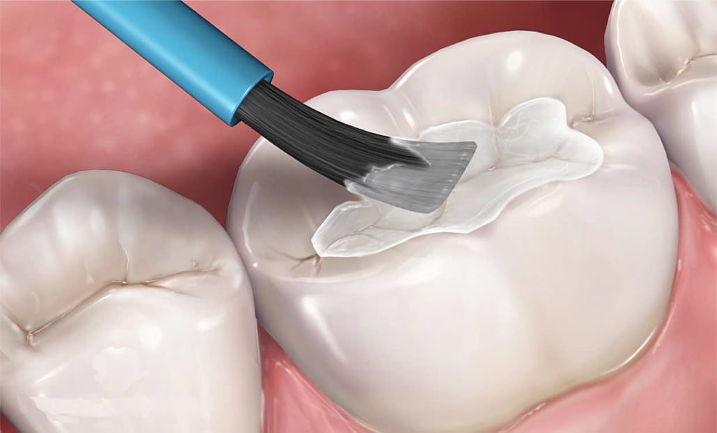 فیشور سیلانت دندان یا شیاربندی دندان ها با ماده مخصوص