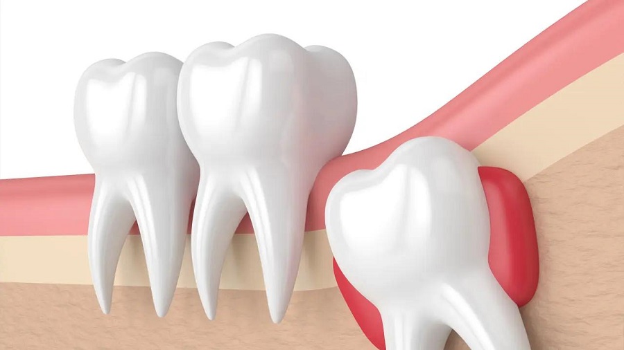 علت کشیدن دندان عقل و آسیب به سایر دندان ها