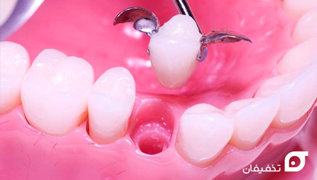 مشکلات بریج دندان