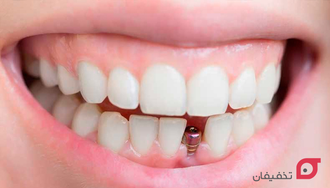 انواع بریج دندان