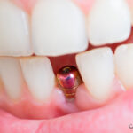 بریج دندان چیست | طول عمر و انواع بریج | مزایا و هزینه 1404 18 بریج دندان