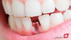 بریج دندان چیست | طول عمر و انواع بریج | مزایا و هزینه ۱۴۰۴