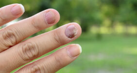 بیماری قارچ ناخن دست