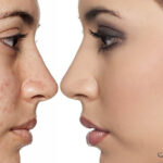 لیزر جای جوش | تعداد جلسات | هزینه + عوارض | عکس قبل و بعد 23 دادن لیزر جای جوش