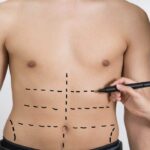 لیپوماتیک چیست | مزایا و عوارض | Bmi و وزن مناسب | ماندگاری 25 لیپوماتیک چیست