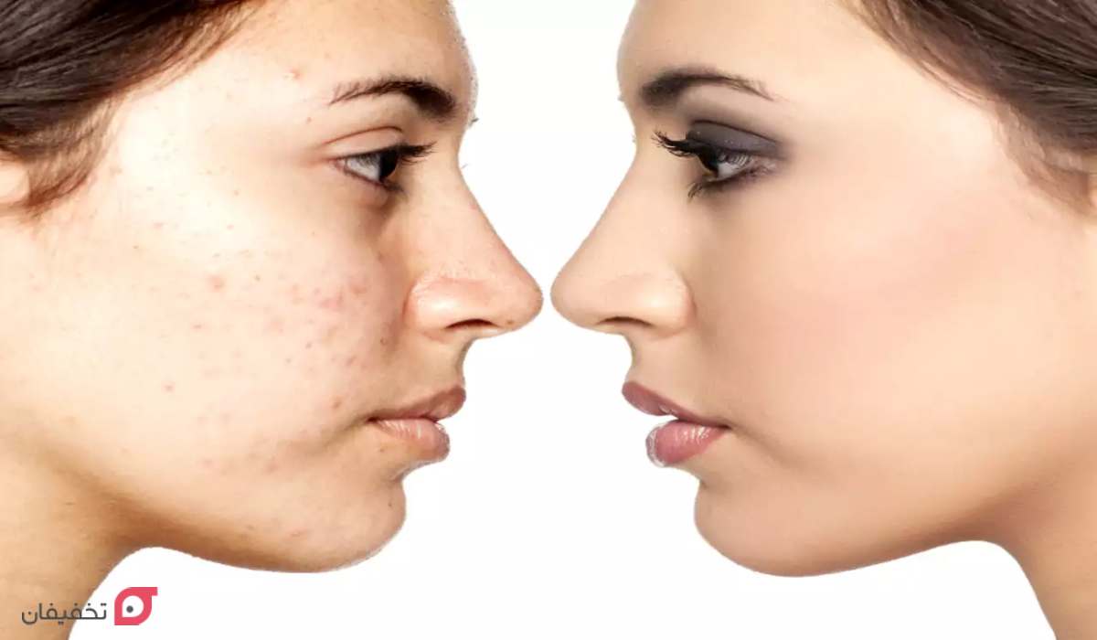 سریع ترین راه از بین بردن لک قهوه ای صورت