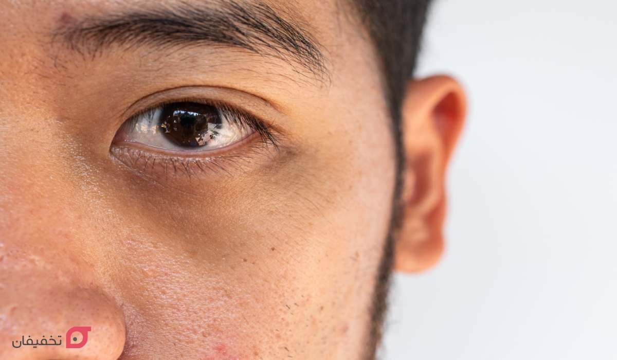 سیاهی زیر چشم ارثی