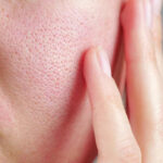منافذ باز صورت چیست + 7 روش درمان قطعی خانگی و پزشکی 32 درمان منافذ باز پوست