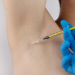 بوتاکس زیر بغل چیست | نحوه و نقاط تزریق + عوارض و مراقبت ها 17 بوتاکس زیر بغل