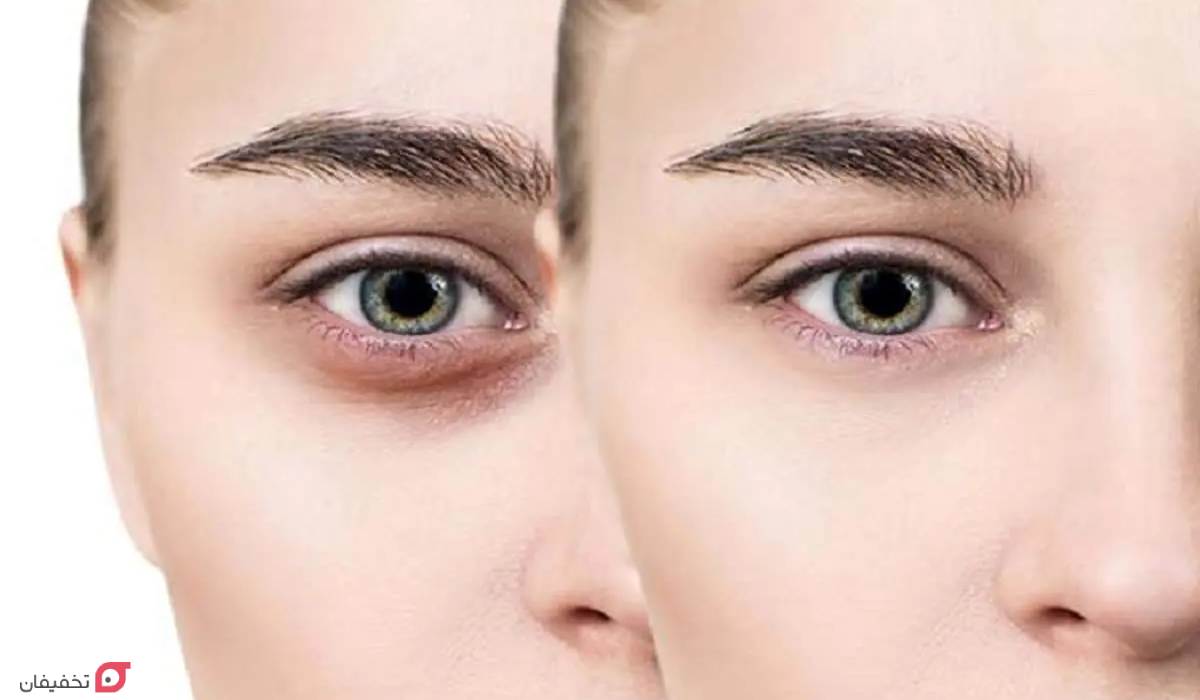 کربوکسی تراپی برای لاغری