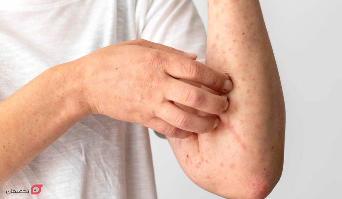 علائم کبد چرب روی پوست