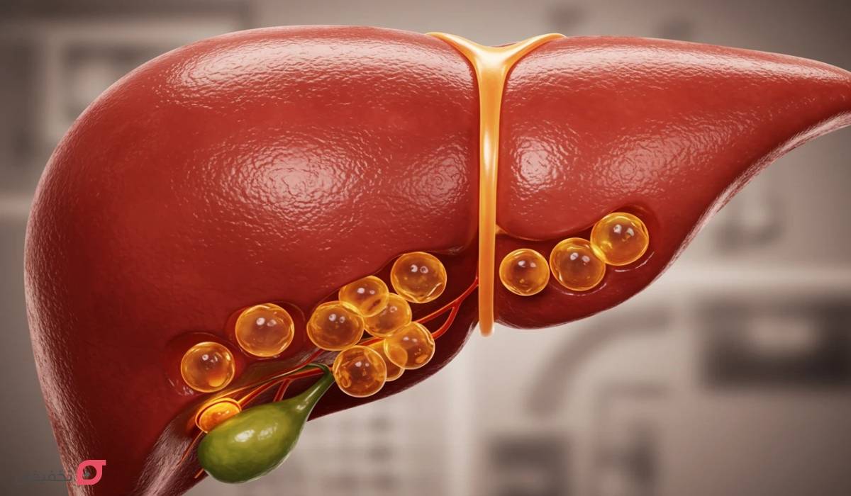 علائم کبد چرب گرید ۴