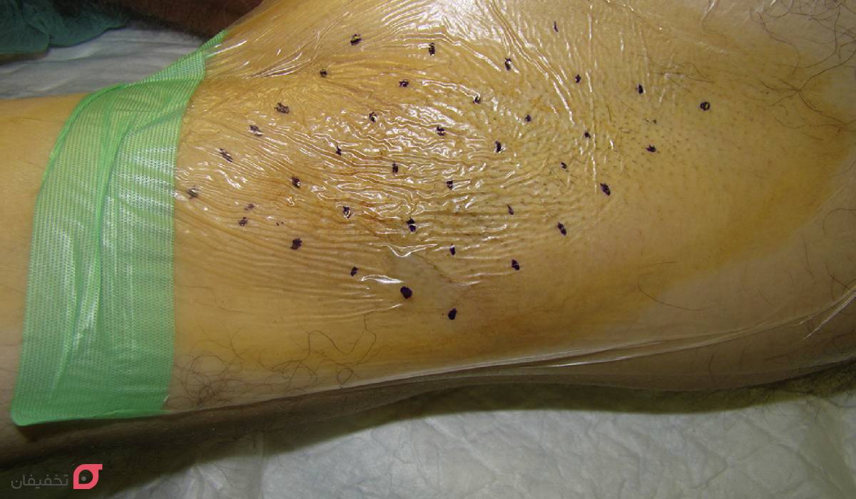 نواحی درمان تعریق با تزریق بوتاکس