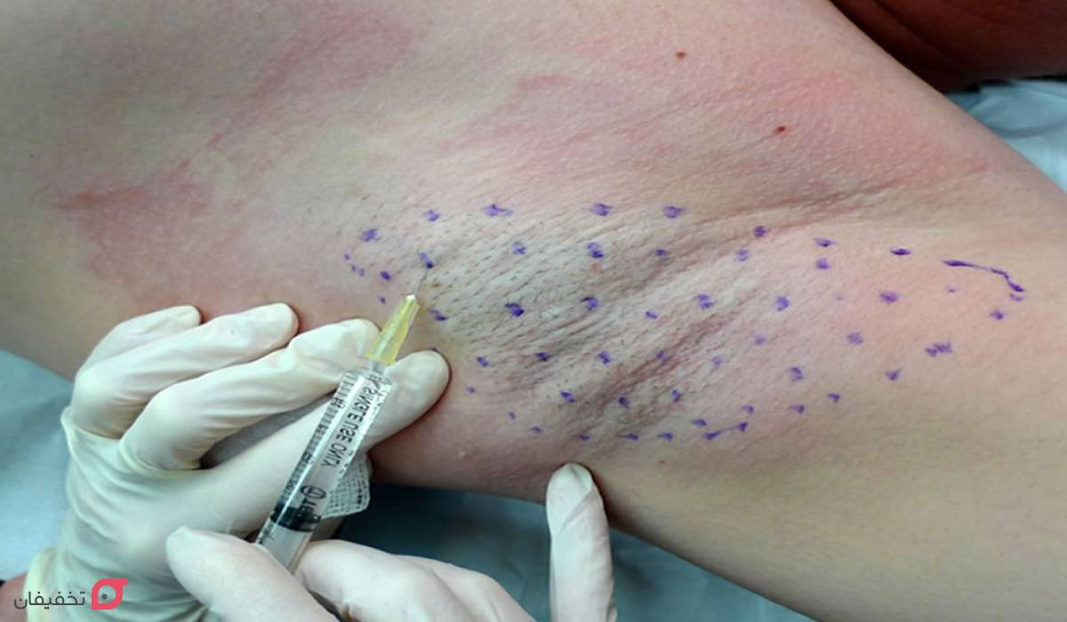 نحوه تزریق بوتاکس زیر بغل