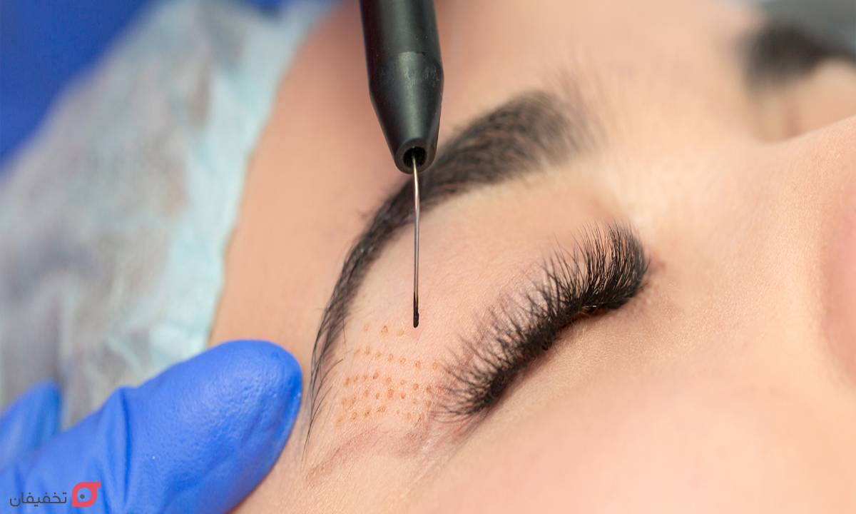 رفع افتادگی پلک