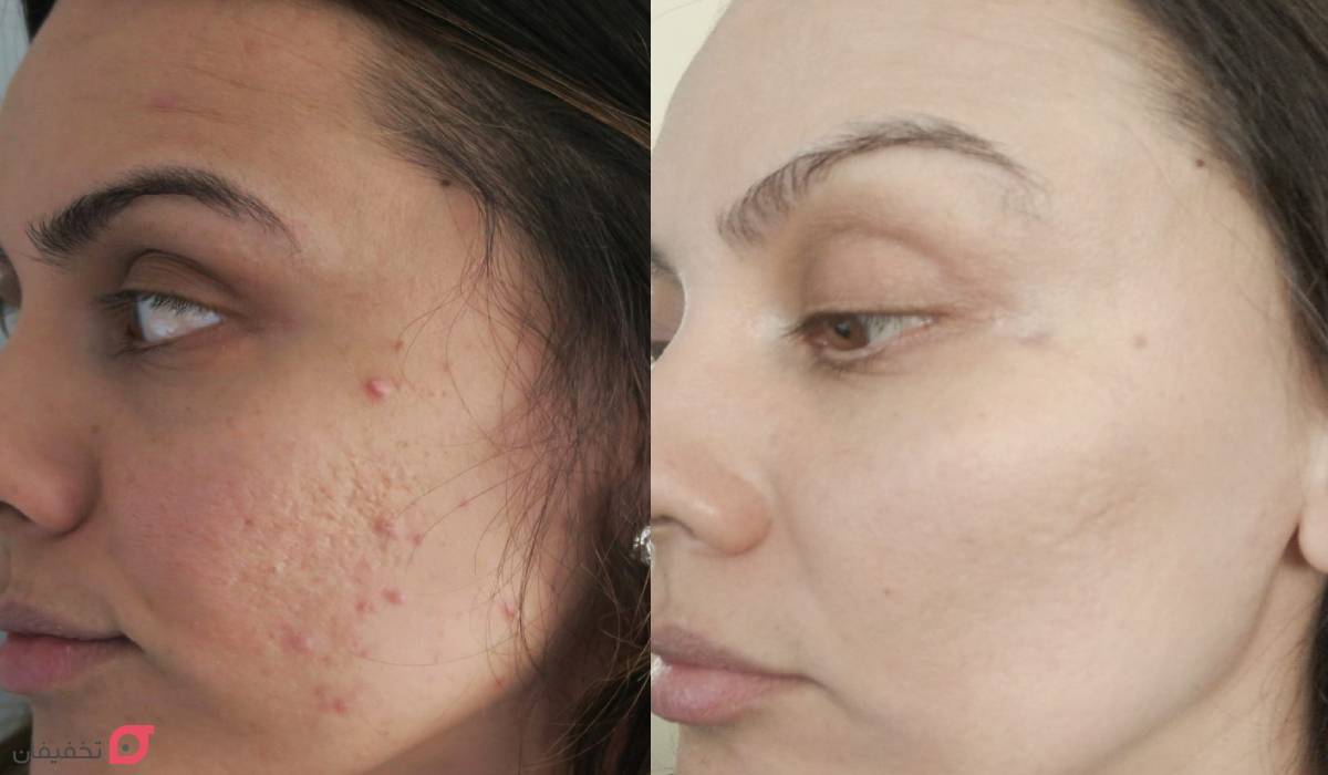 عکس صورت بعد از میکرونیدلینگ