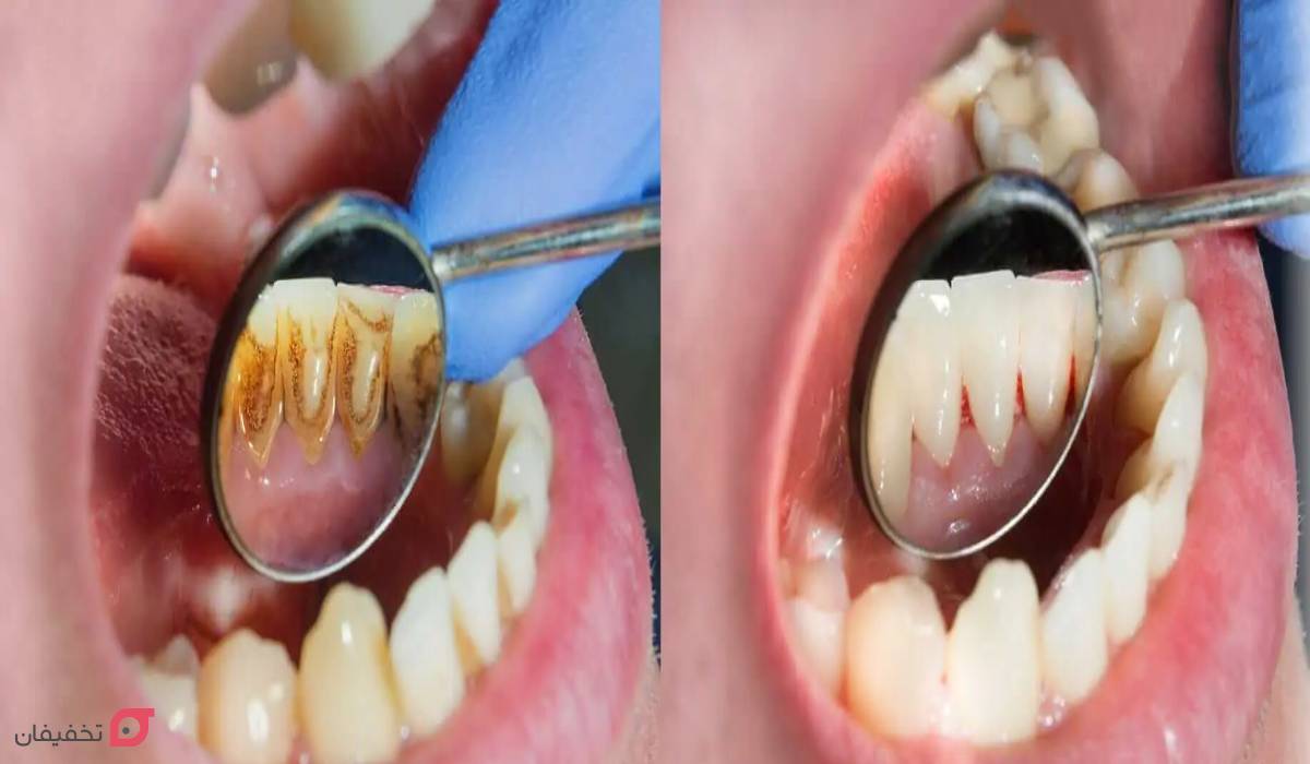عکس قبل و بعد جرم گیری دندان