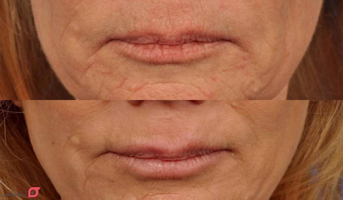 عکس صورت بعد از میکرونیدلینگ