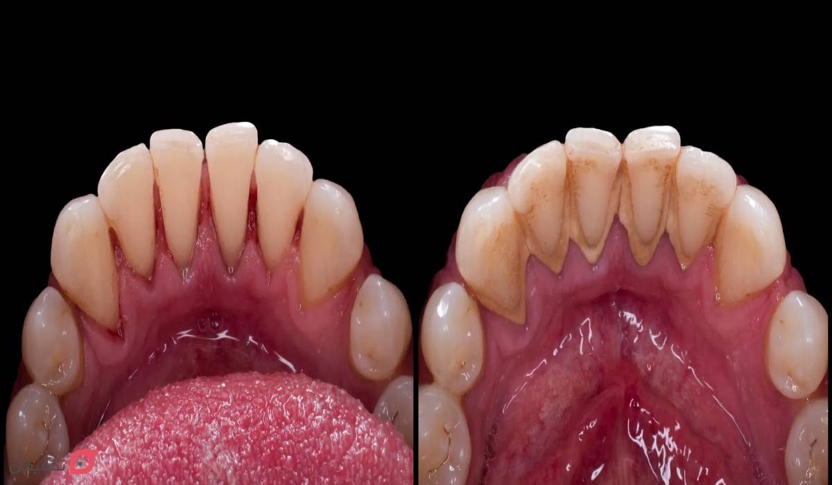 عکس قبل و بعد جرم گیری دندان