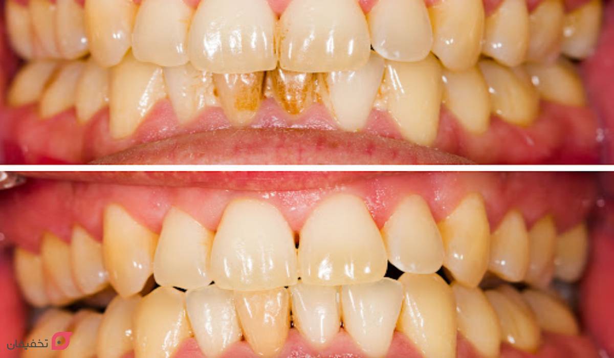 عکس قبل و بعد جرم گیری دندان