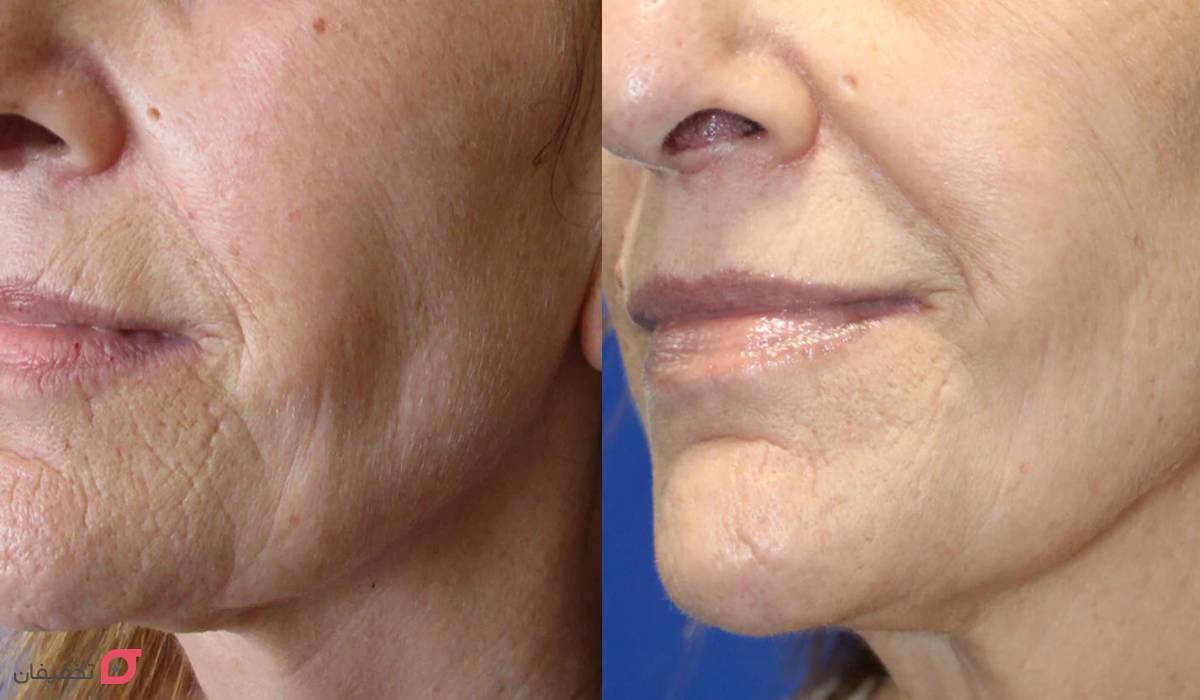 آر اف فرکشنال چیست | کاربرد برای صورت | عوارض و ماندگاری 7 آر اف فرکشنال صورت