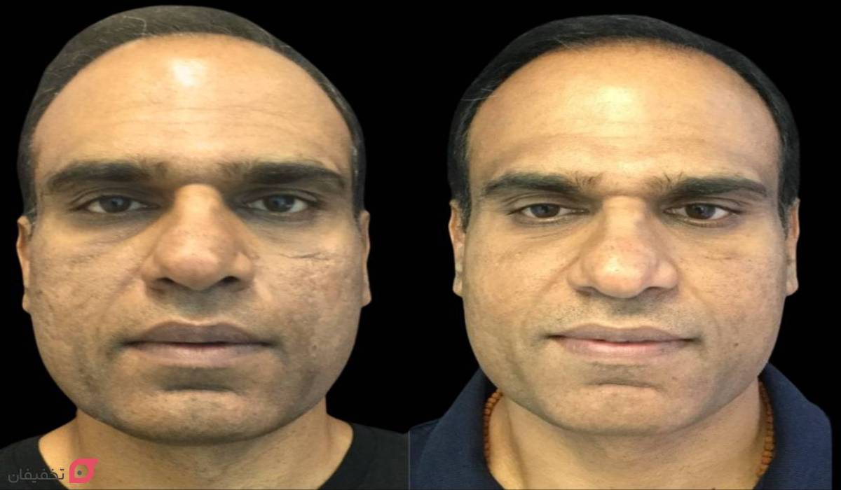 میکرونیدلینگ صورت در خانه