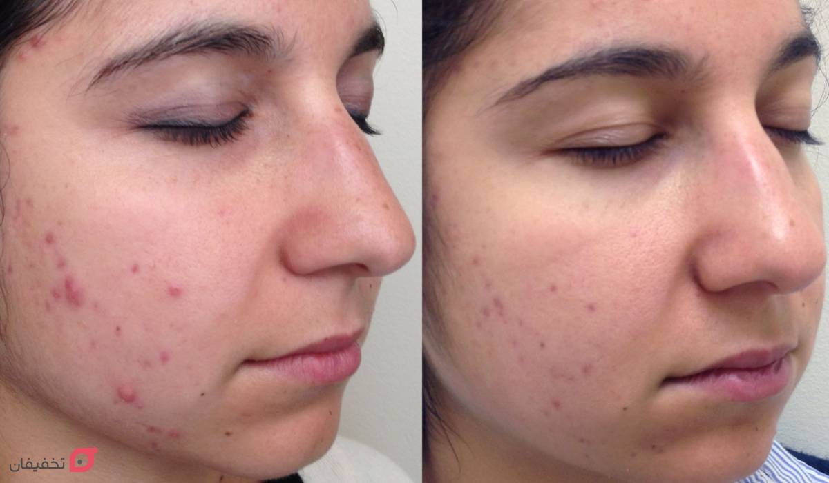 آر اف فرکشنال چیست | کاربرد برای صورت | عوارض و ماندگاری 5 کاربردهای آر اف فرکشنال