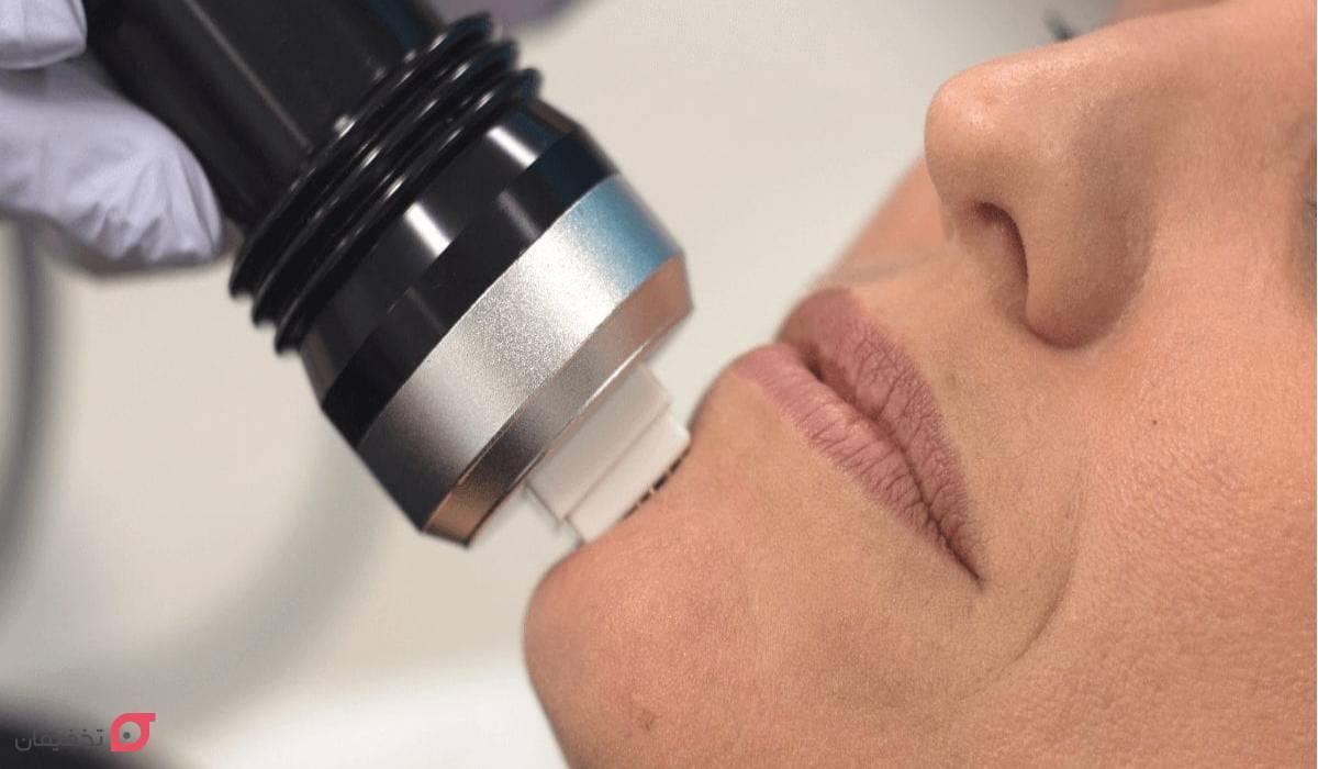 آر اف فرکشنال چیست | کاربرد برای صورت | عوارض و ماندگاری 3 ماندگاری آر اف