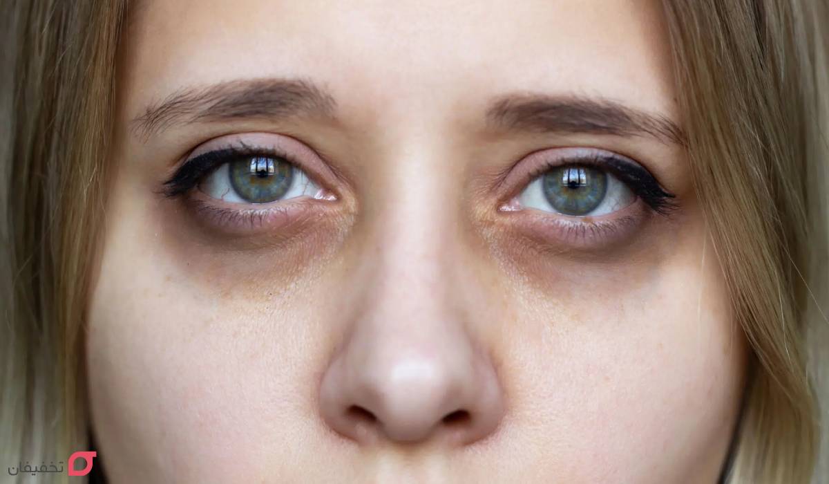درمان گودی زیر چشم در آقایان و زنان | 10 درمان سریع خانگی 5 درمان سریع گودی زیر چشم با روش خانگی