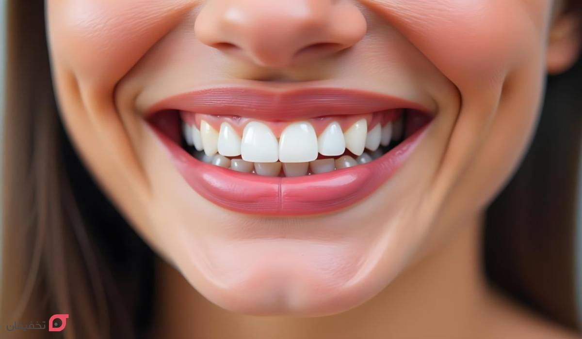 کامپوزیت ونیر چیست | بهترین مارک | تفاوت با کامپوزیت |عوارض 3 کامپوزیت ونیر سرامیکی