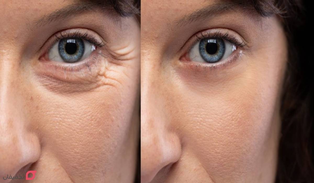 بوتاکس صورت قبل و بعد