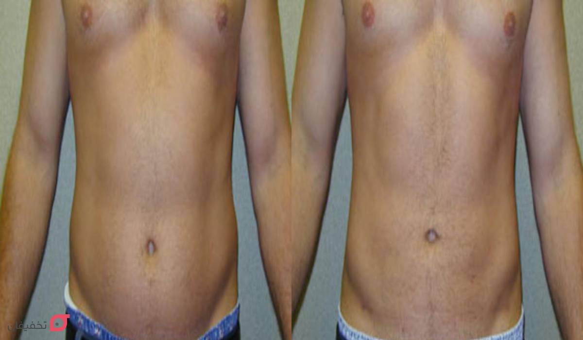 لیپوماتیک چیست | مزایا و عوارض | Bmi و وزن مناسب | ماندگاری 5 لیپوماتیک