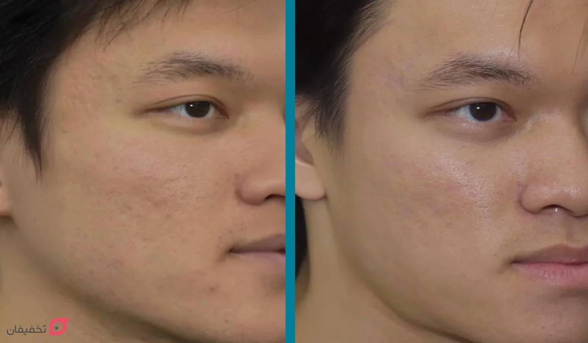 لیزر جای جوش | تعداد جلسات | هزینه + عوارض | عکس قبل و بعد 12 عکس قبل و بعد از لیزر جای جوش