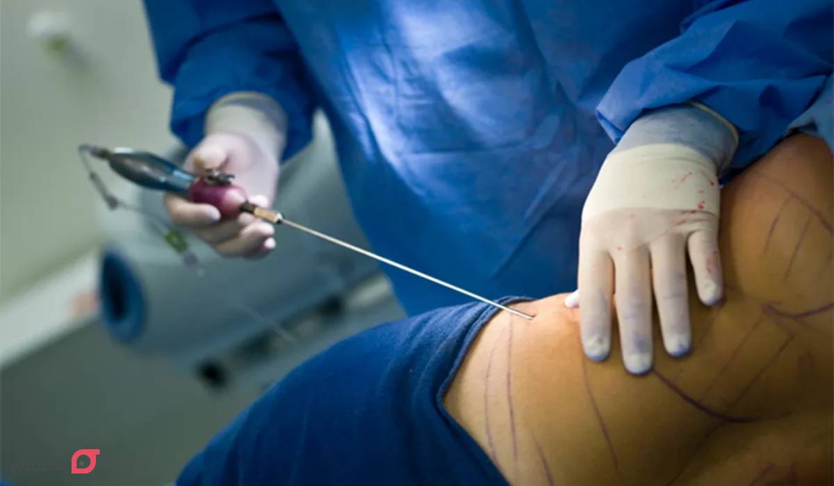 لیپوماتیک چیست | مزایا و عوارض | Bmi و وزن مناسب | ماندگاری 7 لیپوماتیک