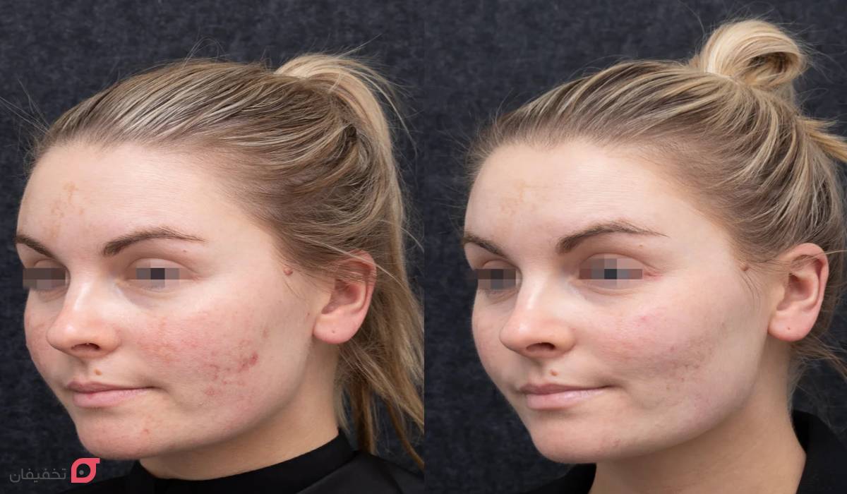 لیزر جای جوش | تعداد جلسات | هزینه + عوارض | عکس قبل و بعد 4 عکس قبل و بعد از لیزر جای جوش