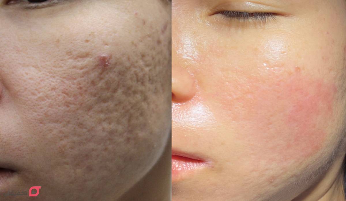 لیزر جای جوش | تعداد جلسات | هزینه + عوارض | عکس قبل و بعد 10 عکس قبل و بعد از لیزر جای جوش