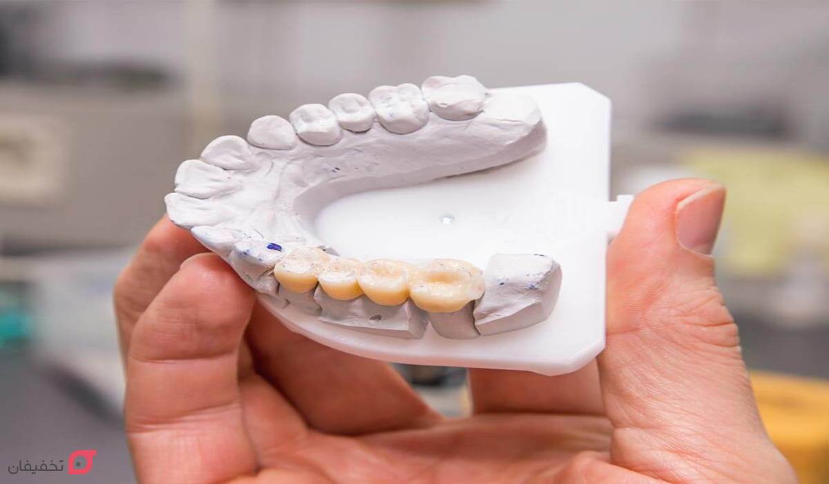 بریج دندان چگونه انجام می شود؟