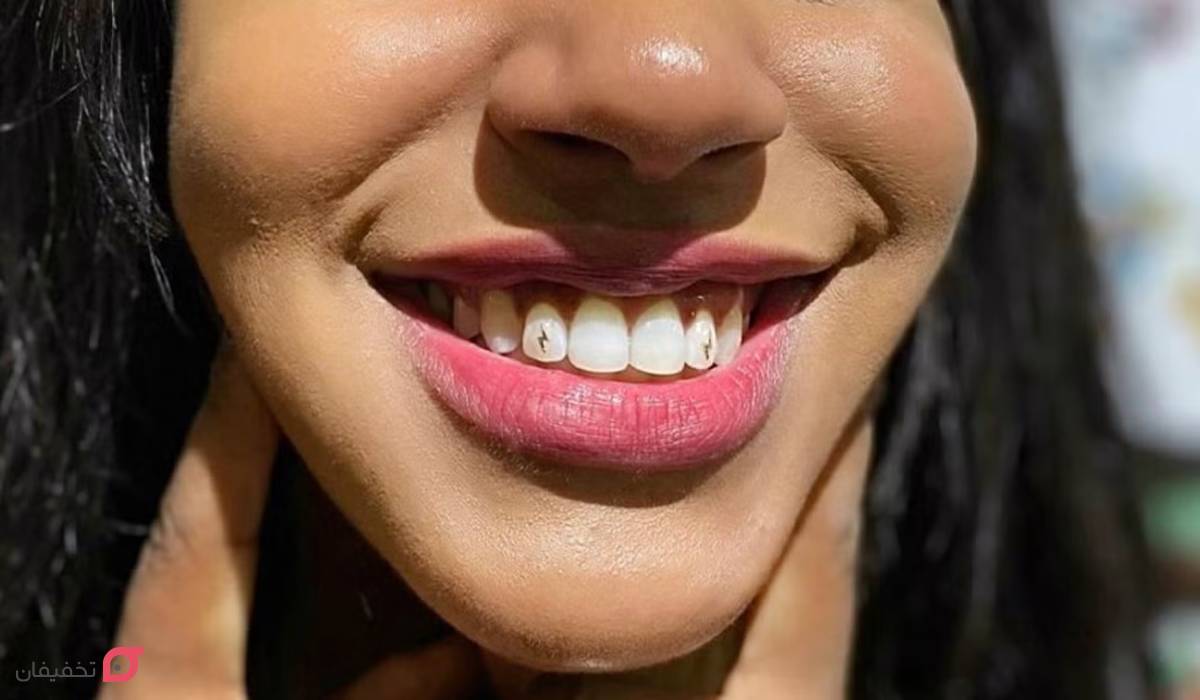 بهترین روش زیبایی دندان چیست | از بلیچینگ تا جوش شیرین 7 بهترین روش زیبایی دندان