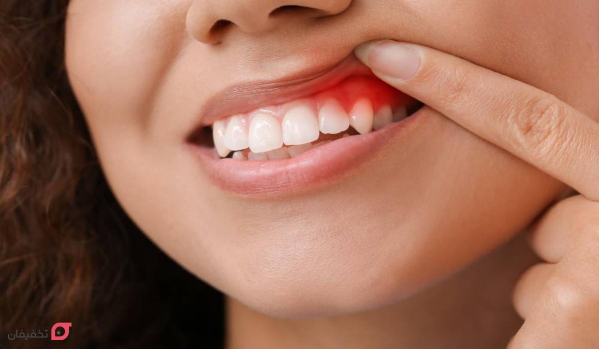 بهترین روش زیبایی دندان چیست | از بلیچینگ تا جوش شیرین 5 بهترین روش زیبایی دندان