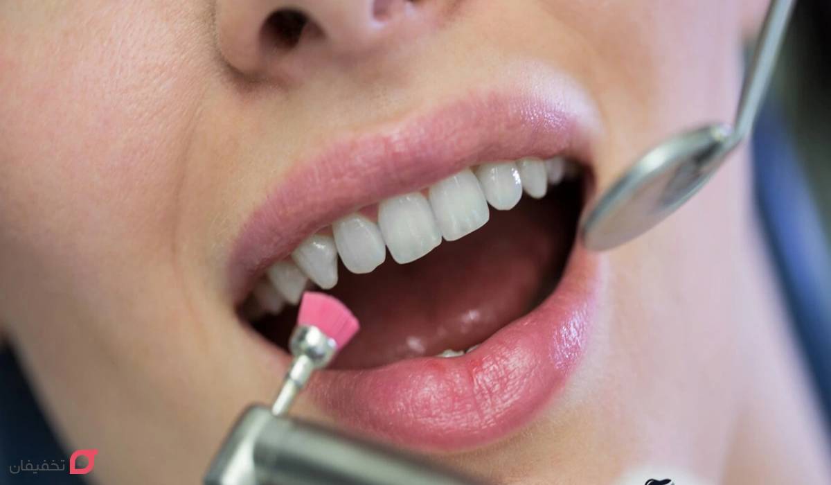 کامپوزیت ونیر چیست | بهترین مارک | تفاوت با کامپوزیت |عوارض 7 مزایای کامپوزیت دندان