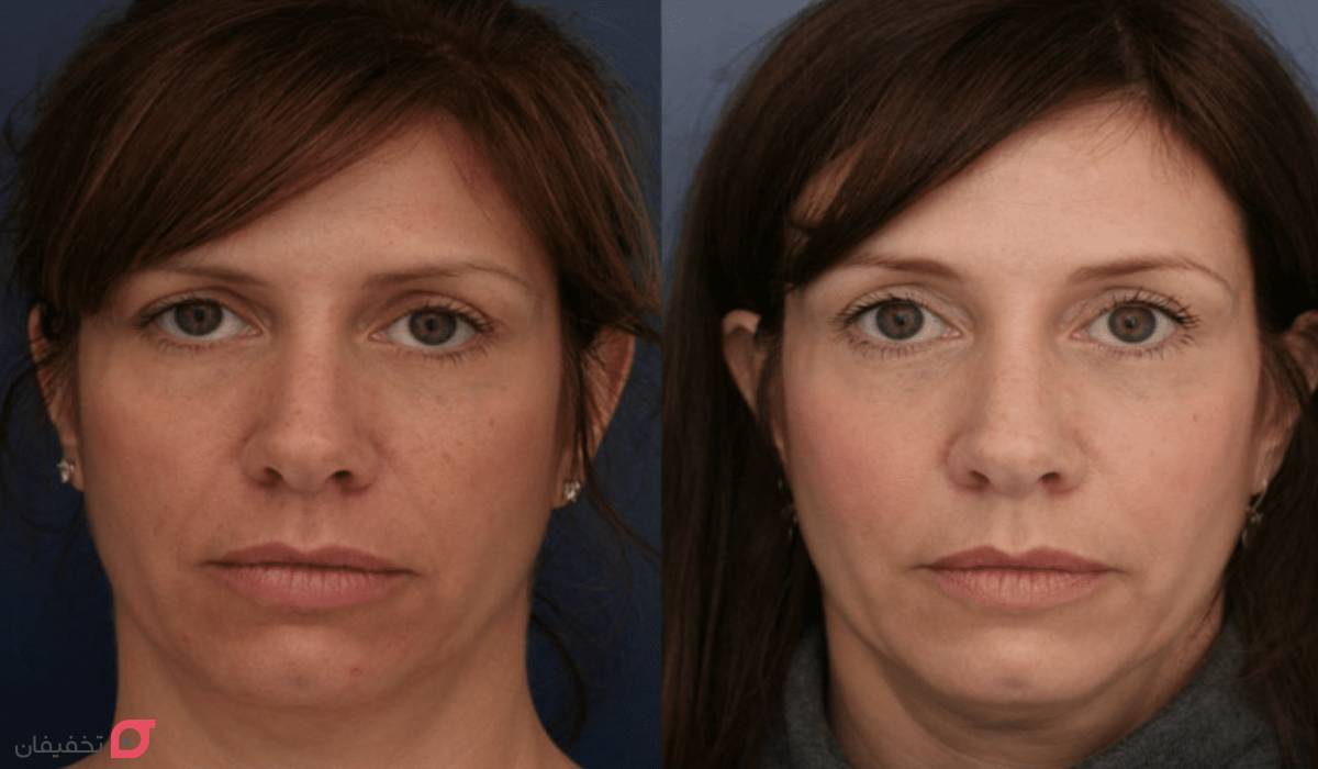 لیفت ابرو چیست | ماندگاری و انواع | عوارض و مزایا | عکس 8 لیفت ابرو
